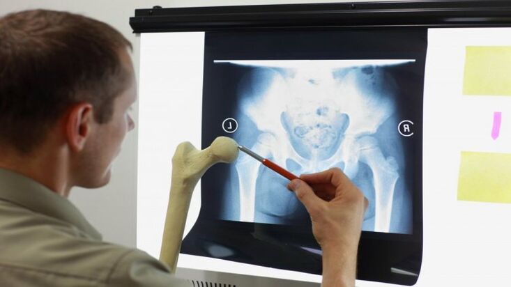 Der Arzt untersucht ein Röntgenbild, um eine Arthrose der Hüfte festzustellen.