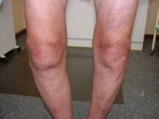 Symptome einer Arthrose des Kniegelenks.